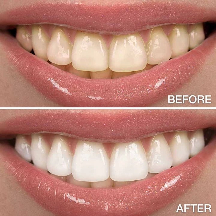 Novashine Teeth Whitening Kit with LED Light Mouthpiece